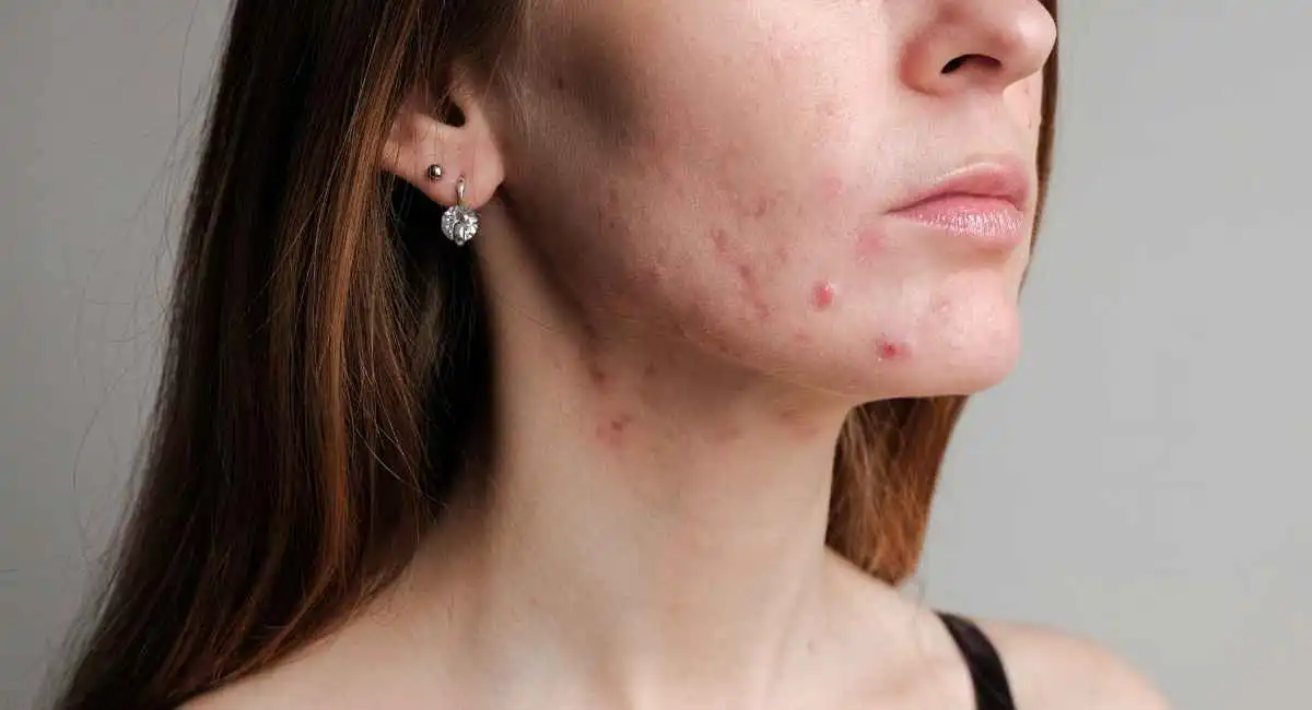 Spuogai – kaip ir kada kreiptis į gydytoją dermatologą