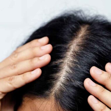 Sausa galvos oda – priežiūra ir gydymas