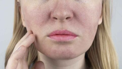 Efektyvi riebios veido odos priežiūra, oda su padidėjusiomis poromis